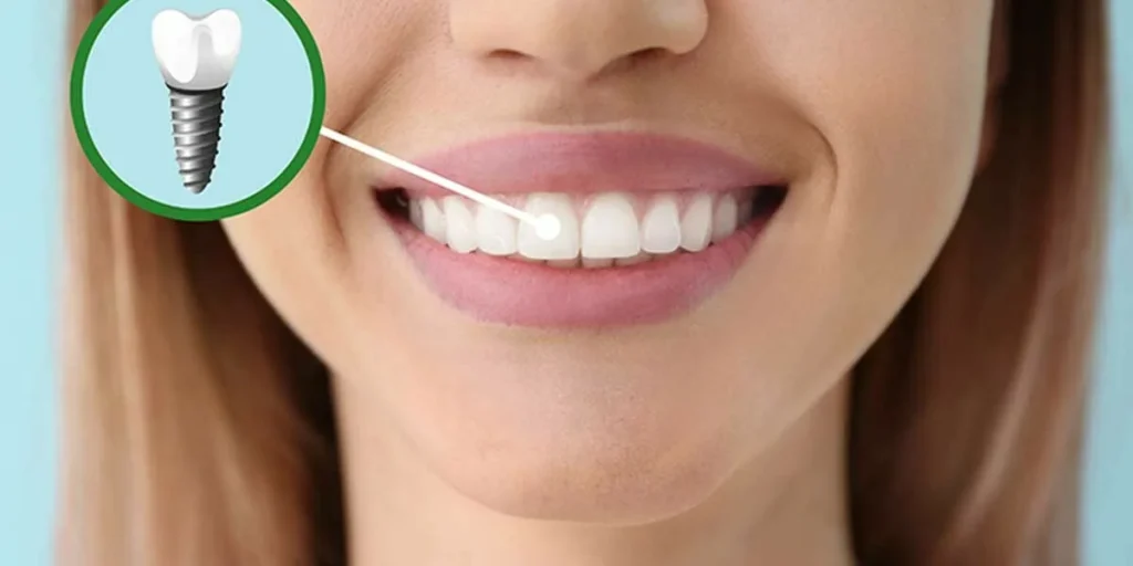 how-to-take-care-of-dental-implants-in-dubai