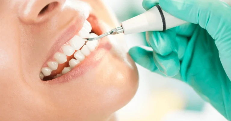 Does Scaling and Polishing Whiten Teeth | Enfield Dental Clinic