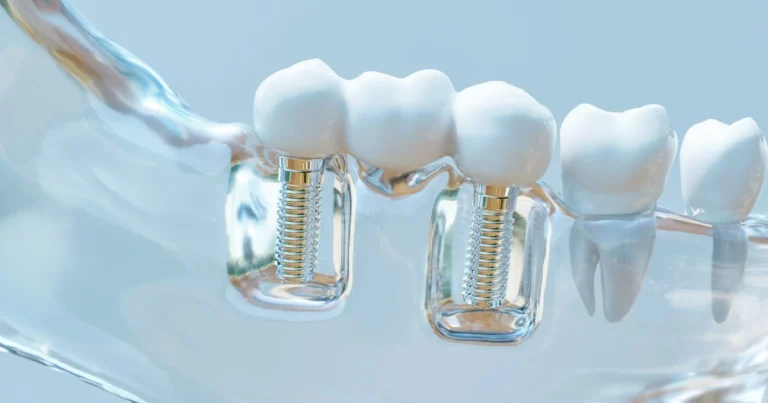 How Do You Keep Dental Implants From Failing? 2 How Do You Keep Dental Implants From Failing | Enfield Dental