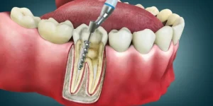 How Long Do Teeth Survive After A Root Canal in Dubai 2 How Long Do Teeth Survive After A Root Canal in Dubai