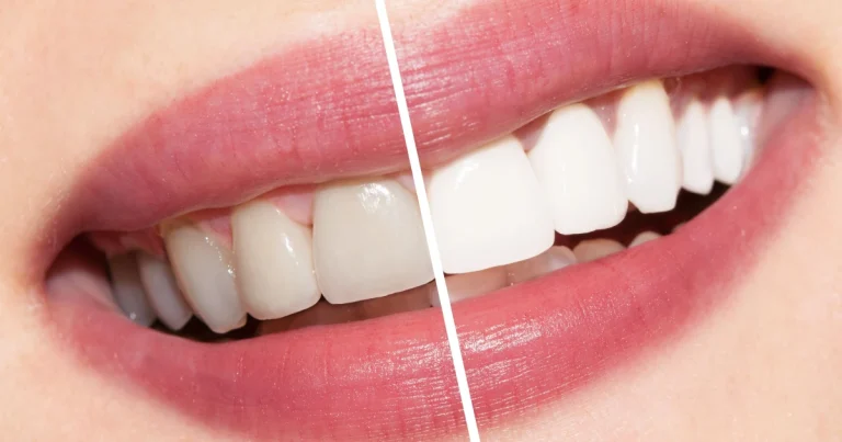 How Long Does It Take To Whiten My Teeth? 1 How Long Does It Take To Whiten My Teeth | Enfield Dental