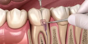 Root Canal Treatment Cost in Dubai | Root Canal Treatment Cost near me 1 Root Canal Treatment Cost in Dubai | Root Canal Treatment Cost near me