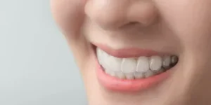 6 Ways to Straighten Your Teeth Without Braces