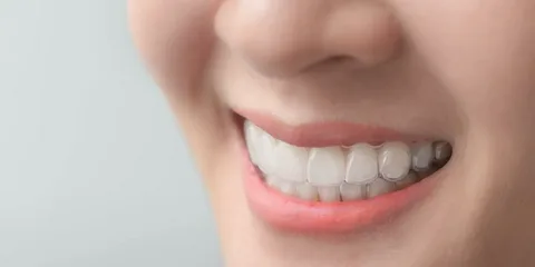 Blogs 21 6 Ways to Straighten Your Teeth Without Braces