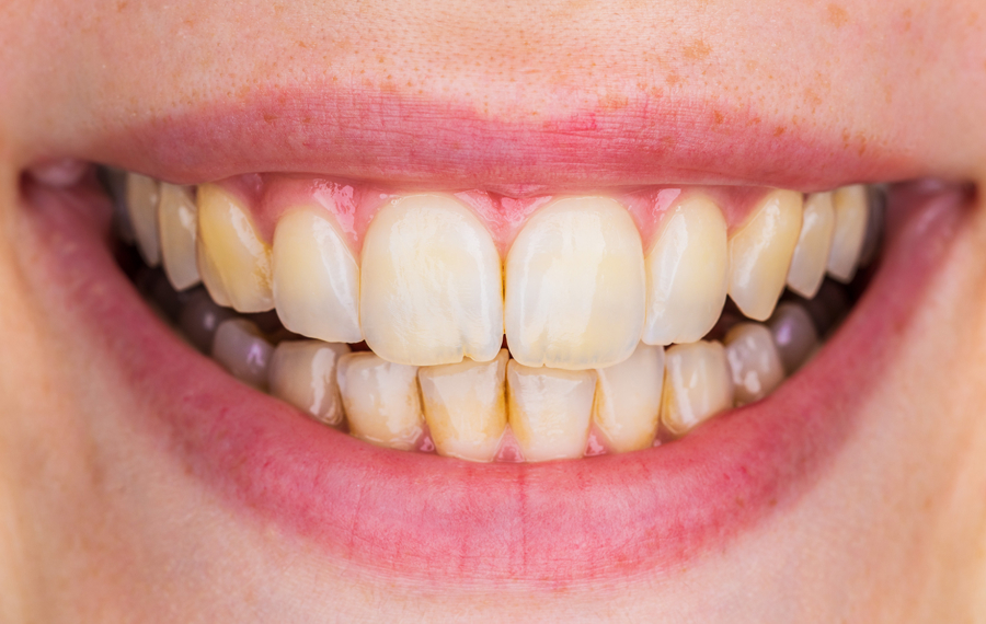Before teeth cleaning treatment in Dubai at Enfield Dental Clinic Before teeth cleaning treatment in Dubai at Enfield Dental Clinic
