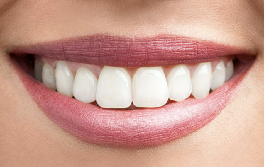 After photo of teeth cleaning treatment in Dubai showing smooth enamel surface, restored whiteness, and improved gum health