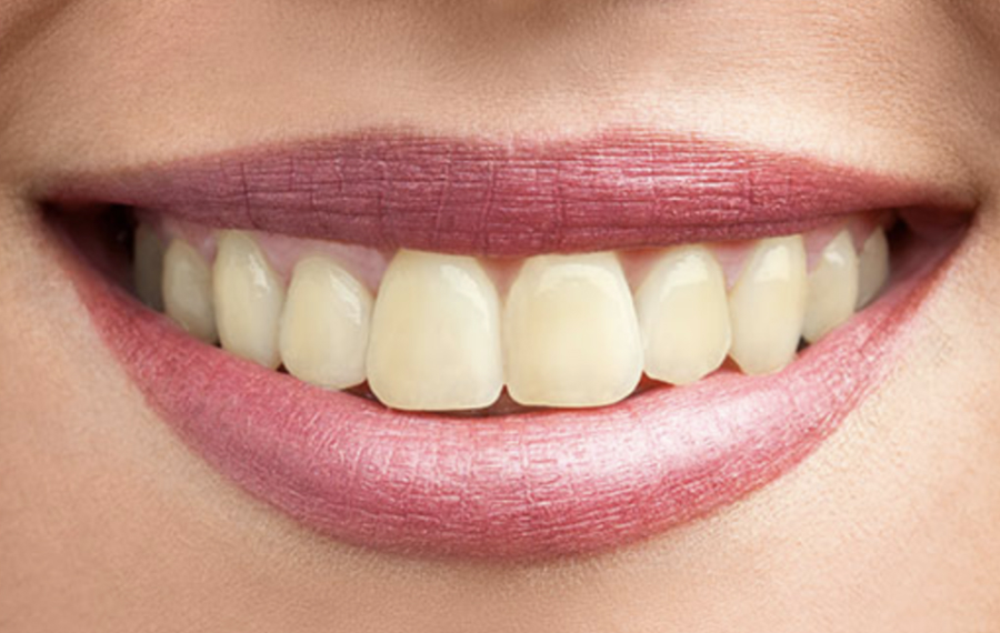 Before photo of dental scaling and teeth cleaning in Dubai showing yellowing Before photo of dental scaling and teeth cleaning in Dubai showing yellowing