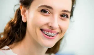 Teeth Braces Price in Dubai