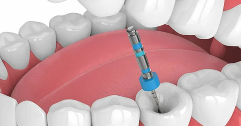What To Expect From A Root Canal Procedure?