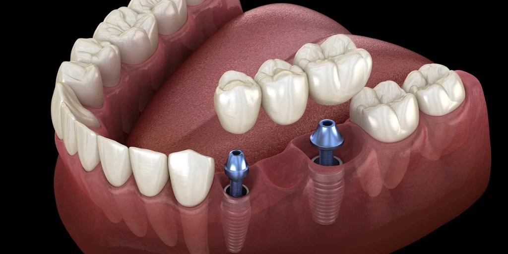 How much does a dental bridge cost in Dubai