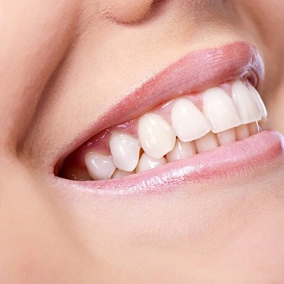 Full Mouth Rehabilitation Cost in Dubai