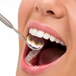 Lingual Braces Cost In Dubai (1)