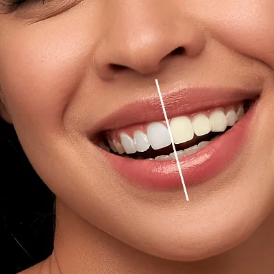 Nano Teeth Whitening Cost in Dubai (1)