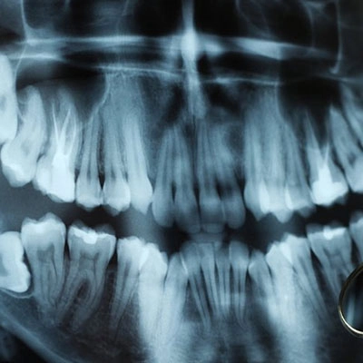 OPG X ray Cost in Dubai