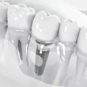 Same Day Dental Implants Cost in Dubai