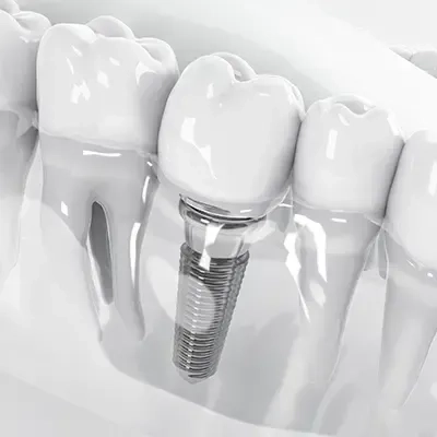 Same Day Dental Implants Cost in Dubai (1)