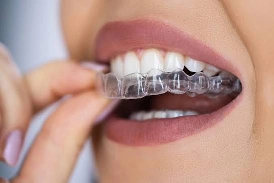 Teeth Retainers
